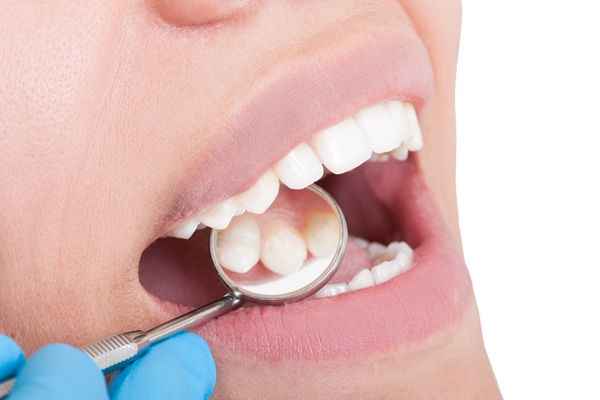 Old Dental Fillings? Common Signs You May Need A New One