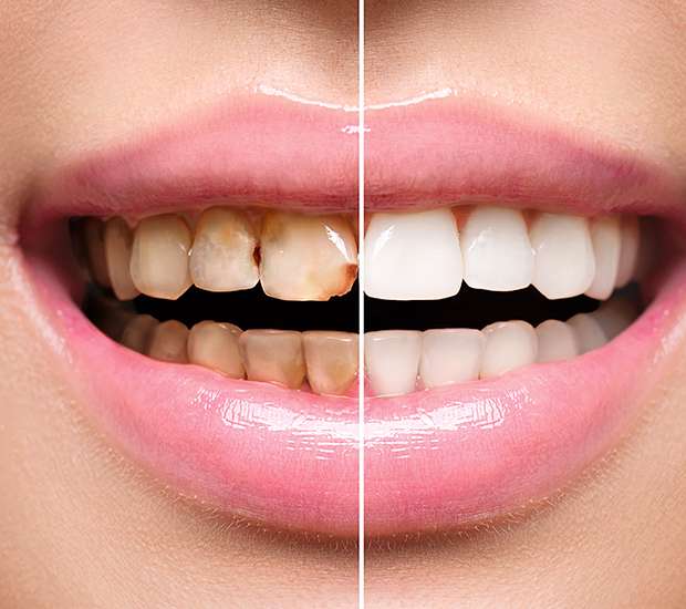 Grafton Dental Implant Restoration