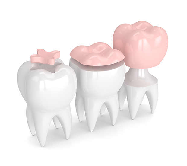 Grafton Dental Inlays and Onlays