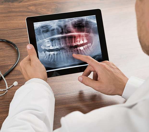 Grafton Types of Dental Root Fractures