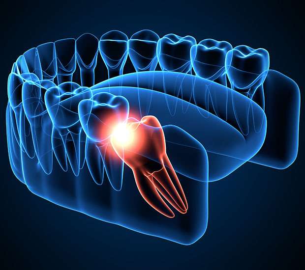 Grafton Wisdom Teeth Extraction